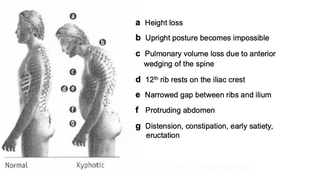 Physical Therapy in our clinic for Spinal Compression Fractures